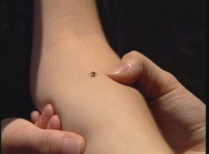 A kullancs gyors,biztonságos eltávolítása - Égési sérülés hatékony kezelése