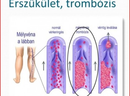 Érszűkület tünetei és a természetes gyógymódok - praktikák !