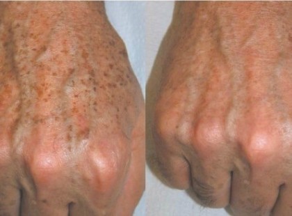 Így tüntessük el bőrünk barna elváltozásait!