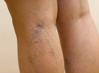 Hogyan csökkenthető a visszeres láb fájdalma? 10 tipp az orvostól és természetgyógyásztól!