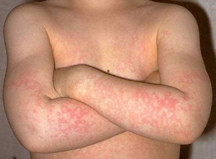 Támad a lepkehimlő!