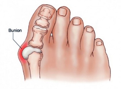 Így kezeljük a lábbütyköt ezzel a könnyű, de hatékony módszerrel