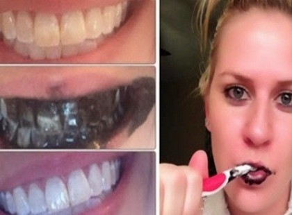 Egy hét alatt garantáltan fehérebb lehet a fogad ezzel a módszerrel