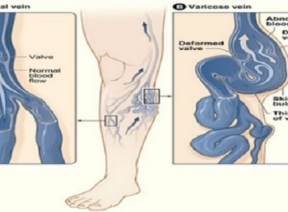 Nem kell többé a visszértágulatokkal bajlódni, ezzel a 3 természetes gyógymóddal rendbe tehetjük a problémát