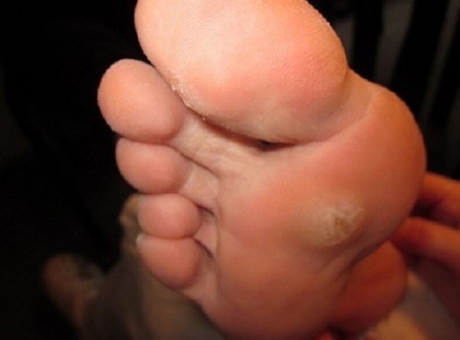 A tyúkszem kezelésének 7 aranyszabálya! Ha betartod megszabadulsz tőle!