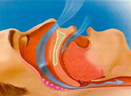 Így lehet megállítani a horkolást örökre