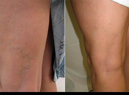 Ezzel a természetes keverékkel hatékonyan kezelhető a visszérgyulladás – Így készíts fokhagyma olajat!