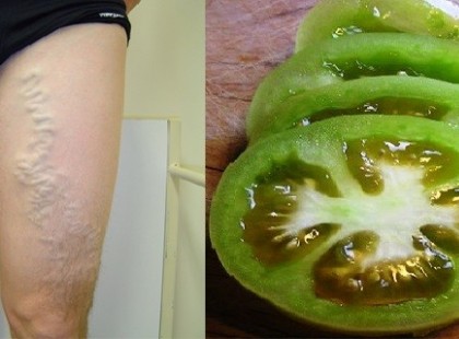 Így gyógyíthatjuk meg a visszeres lábat zöld paradicsom segítségével!