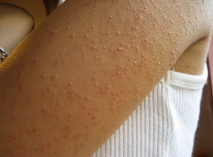 10 jel, ami lisztérzékenységre utalhat