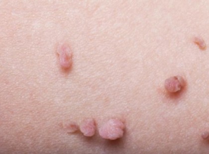 10 természetes gyógymód a bőrkinövések hatékony eltávolítására. Te melyiket ismered?