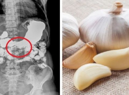 Ez történik , ha éhgyomorra fokhagymát eszel