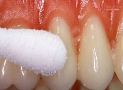 Percek alatt megszabadulhatsz a fogfájástól a következő módszer segítségével