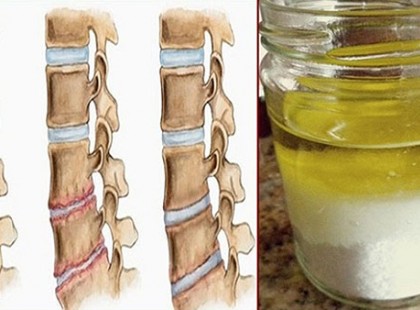 Só-olaj keverék: ha kipróbálod, több évig nem érzel majd fájdalmat!