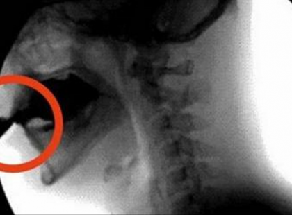 EZ A MÉREG ELPUSZTÍTJA A CSONTOKAT, MÉGIS SOKAN FOGYASZTJÁK NAPONTA