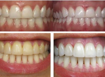 Fogfehérítés házilag 3 perc alatt