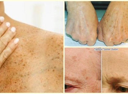 Egy házi kenőcs receptje, ami csodákra képes az öregedési foltokkal!