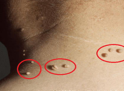 Ezzel az olcsó, otthon megtalálható szerrel gyorsan eltüntetheted a bőrkinövéseidet