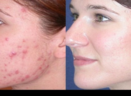 3 nap alatt begyógyítja a pattanásokat ez a gyógyfőzet. Olcsó és hatékony!