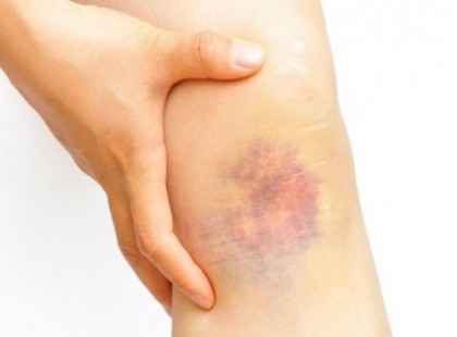 10+1 korai jele annak, hogy rákos vagy