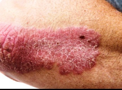 Gyógyíthatatlannak mondott bőrbetegségek szűnnek meg ezekkel a természetes csodaszerekkel!