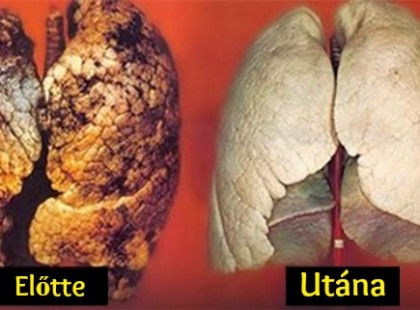 Tisztítsuk meg a tüdőnket 3 nap alatt! Nemcsak dohányosoknak ajánlott kipróbálni a kúrát!