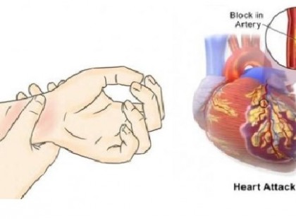 A szívrohamok 80 %-a elkerülhető, ha ezt az 5 dolgot betartod, és ezeket a gyógyszereket örökre elkerülöd!