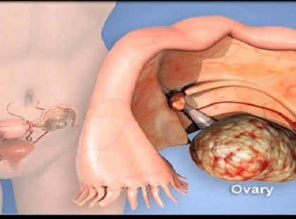 A nők nem figyelnek oda, az orvosok félrediagnosztizálják: ezek jelzi a petefészekrákot, figyelj a tünetekre!