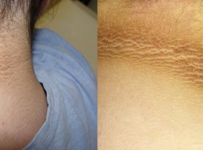 Ezt jelenti a sötét csík a nyakadon