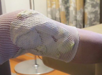 Minden este káposztalevéllel borogatta a térdeit. Alig hitte el, amikor elmúltak a fájdalmai!