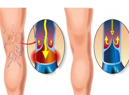 PÁR HÉT ALATT ELTŰNIK A VISSZÉR EZZEL A HÁZI KÉSZÍTÉSŰ OLAJJAL!