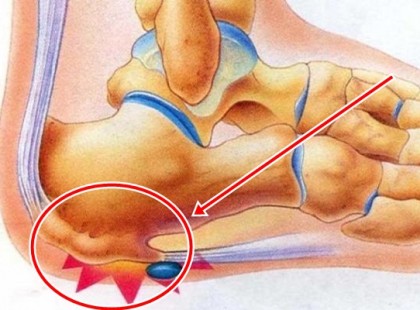 Fájdalom a sarokban- így szüntesd meg természetesen és gyorsan!
