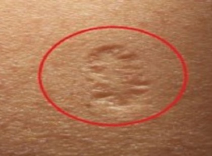 Tudod, hogy mit jelent ez a heg a kar felső részén?