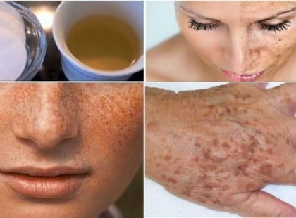Öregségi és pigmentfoltok eltüntetése arcról és kézről csak két háziszerrel