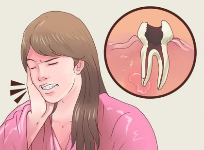 Egy perc alatt elmúlik a fogfájás ezzel a természetes szerrel