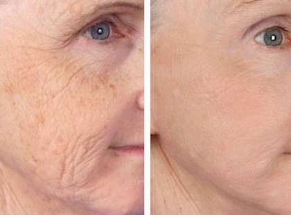 A legmélyebb ráncok is eltűnnek ezzel a házi készítésű krémmel