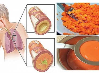 Ez a házi szirup eltávolítja a nyálkát a tüdőből és gyorsan megszünteti a köhögést!