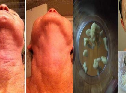 Ez az elképesztő fokhagymás recept egy hét alatt eltünteti minden ráncodat!