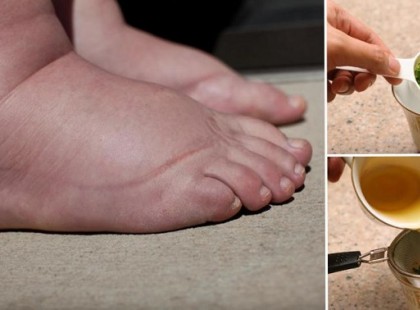 A legjobb tea ödémás lábra, nyáron kelleni fog!
