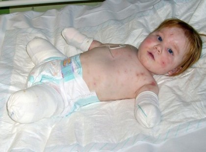 Csecsemőként elvesztette az összes végtagját, nyolc évvel később mégis hatalmas csoda történt vele!