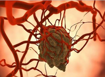 Éheztesd halálra a rákot! Vond meg tőle ezt a táplálékot, hogy meggyógyulj!