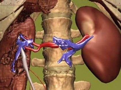 Magas vérnyomással küzdesz? Ne költsd a pénzt drága gyógyszerekre, mutatunk egy ősi, bevált receptet!
