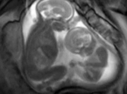 A TERHES NŐ MRI VIZSGÁLATRA MEGY, MEGDÖBBENTŐ, MIT LÁTNAK A MÉHÉBEN!