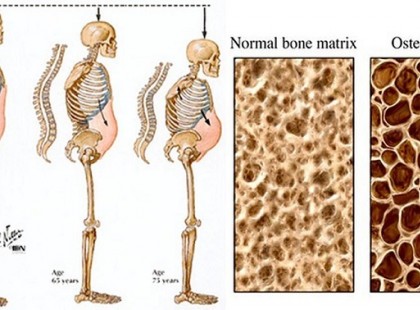 TE MÉG ISZOD EZT A MÉRGET, AMI TÖNKRETESZI A CSONTJAIDAT?