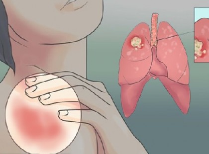 A női tüdőrák figyelmeztető jelei! Ne legyints rájuk!