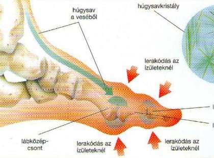 Így oldhatod ki leggyorsabban a húgysavat a testrészeidből, hogy megszűnjön a köszvény és az ízületi fájdalom.
