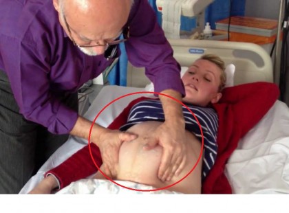 Az orvos megfordítja a harántfekvésű babát kézzel. De aztán nézzék meg a kismama hasát.