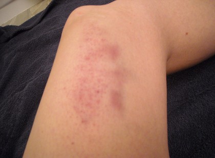 A MÁJKÁROSODÁS ÖT LEGFONTOSABB TÜNETE, AMIT NEM HAGYHATSZ FIGYELMEN KÍVÜL!