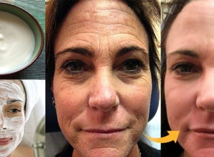 A legdurvább ráncok is eltüntethetőek ezzel a házi módszerrel!