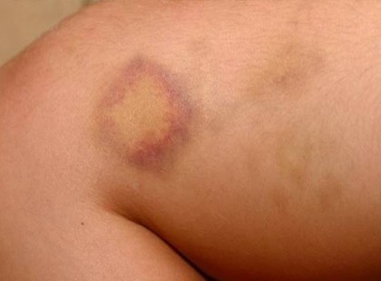 A PAJZSMIRIGY BETEGSÉG REJTETT TÜNETEI, AMIT MINDEN NŐ FIGYELMEN KÍVÜL HAGY!