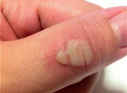 SOSEM GONDOLTAD VOLNA, HOGY EZZEL KELL KEZELNI A MEGÉGETT KEZEDET!